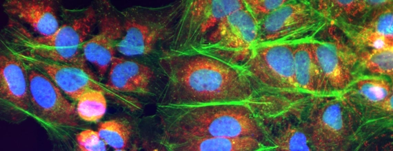 Солидные опухоли